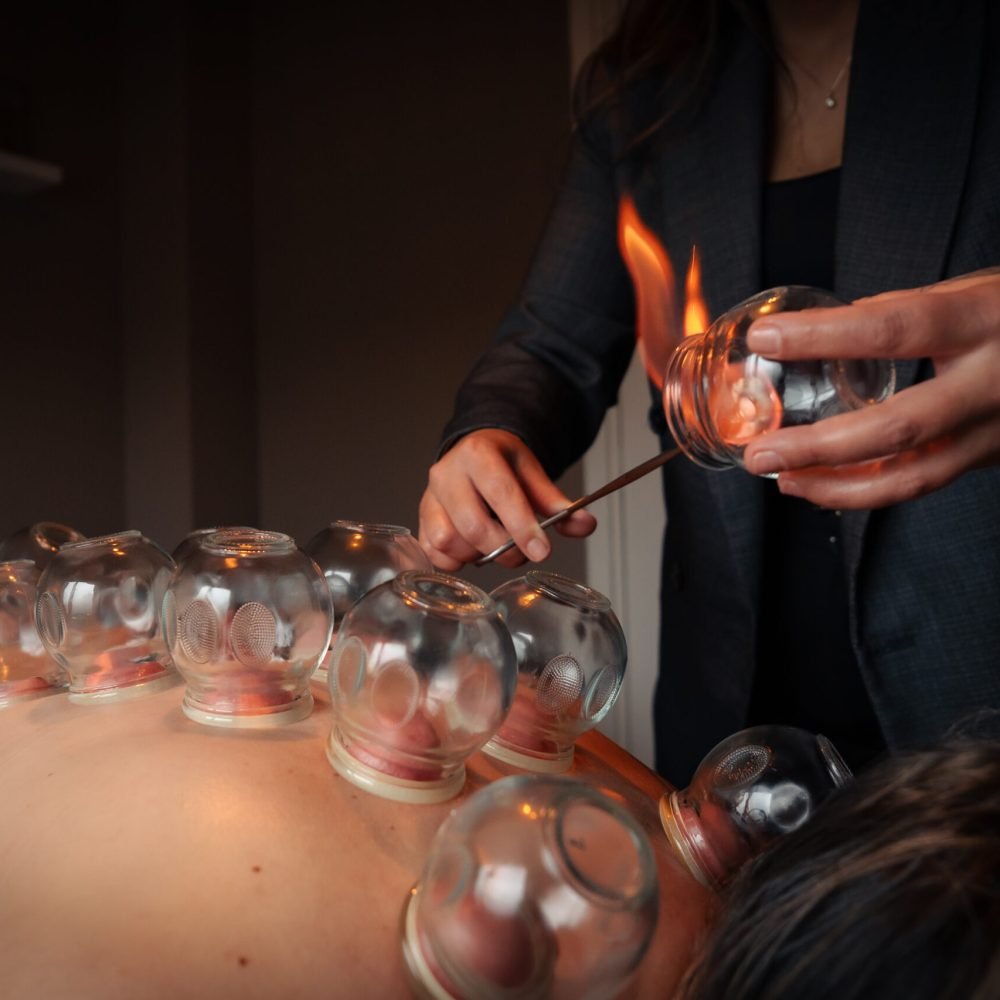 Vuurcuppen behandeling waarbij glazen cups met behulp van een vlam op de huid worden geplaatst